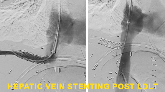 Hepatic-Vein-Stenting-Post-LDLT