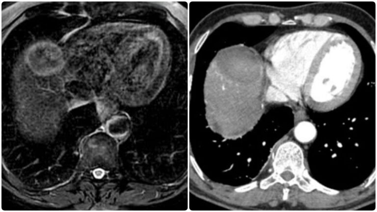 Hepatocellular-Carcinoma