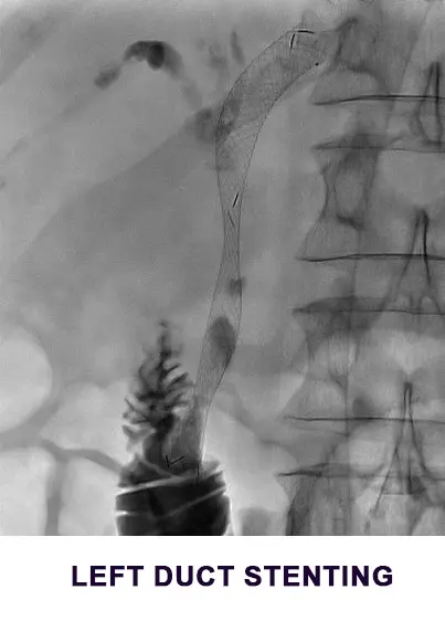 left-duct-stenting