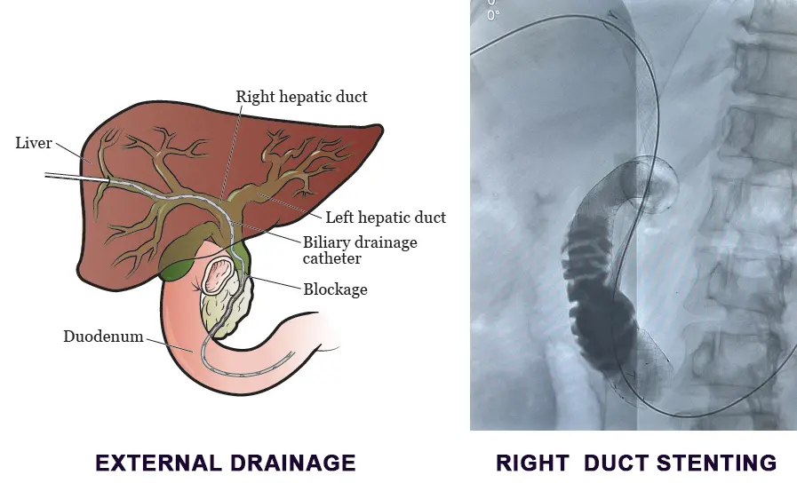 right-duct-biliary-drainage